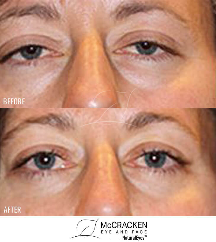 41 year old female – bilateral upper lid ptosis repair, bilateral lower blepharoplasty