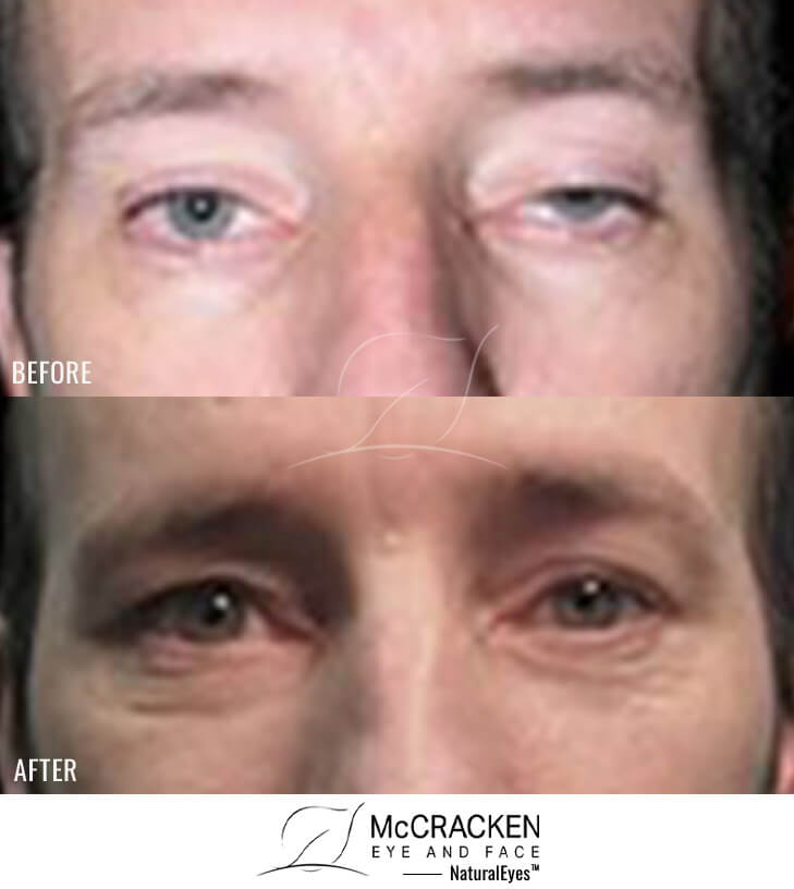 42 Year Old Male – Bilateral Upper Eyelid Ptosis (Droopy Eyelids) Repair