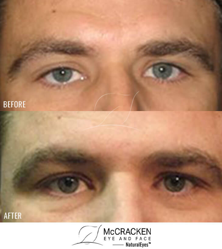 41 Year Old Male – Right Upper Eyelid Ptosis (Droopy Eyelids) Repair