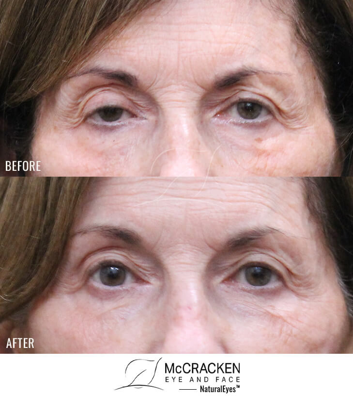 76 year old female – Bilateral Upper Eyelid Ptosis (Droopy Eyelids) Repair
