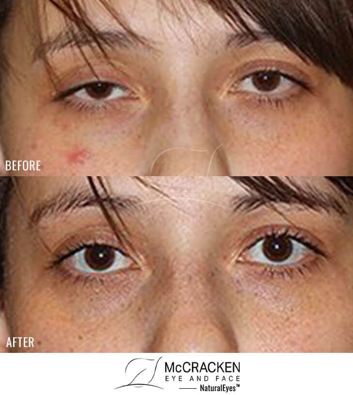 22 year old female – Right Upper Eyelid Ptosis (Droopy Eyelids) Repair
