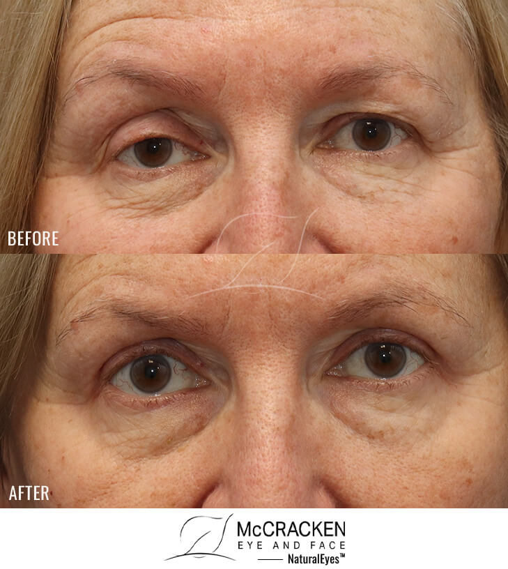 61 year old female – Right Upper Eyelid Ptosis (Droopy Eyelids) Repair with Bilateral Upper Eyelid Ptosis Repair.