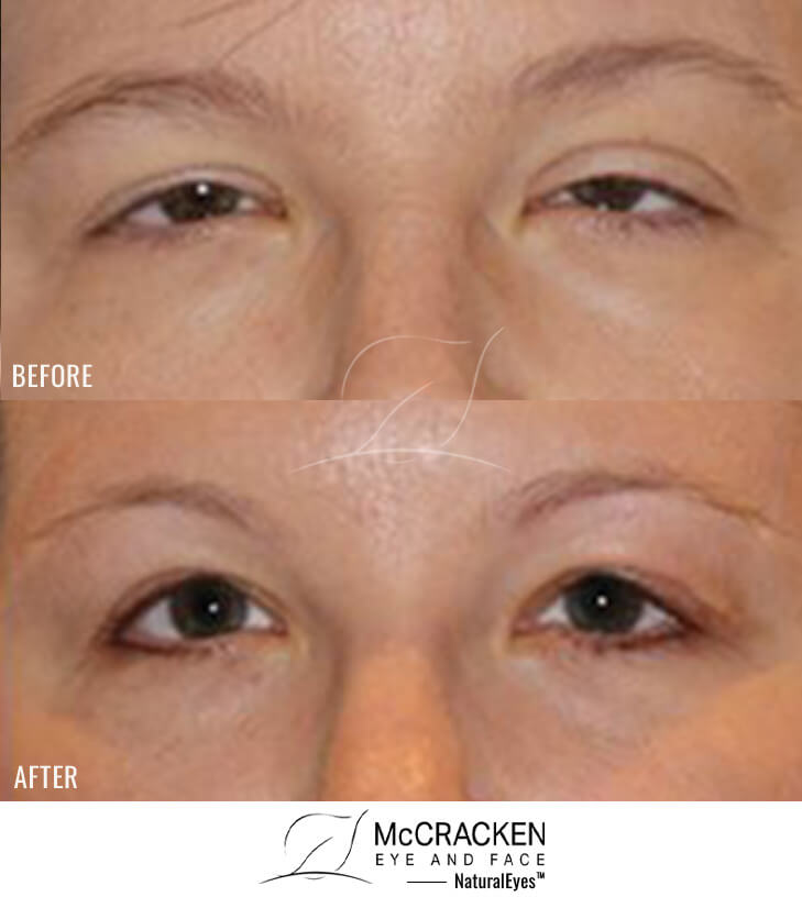 39 year old female – Bilateral Upper Eyelid Ptosis (Droopy Eyelids) Repair