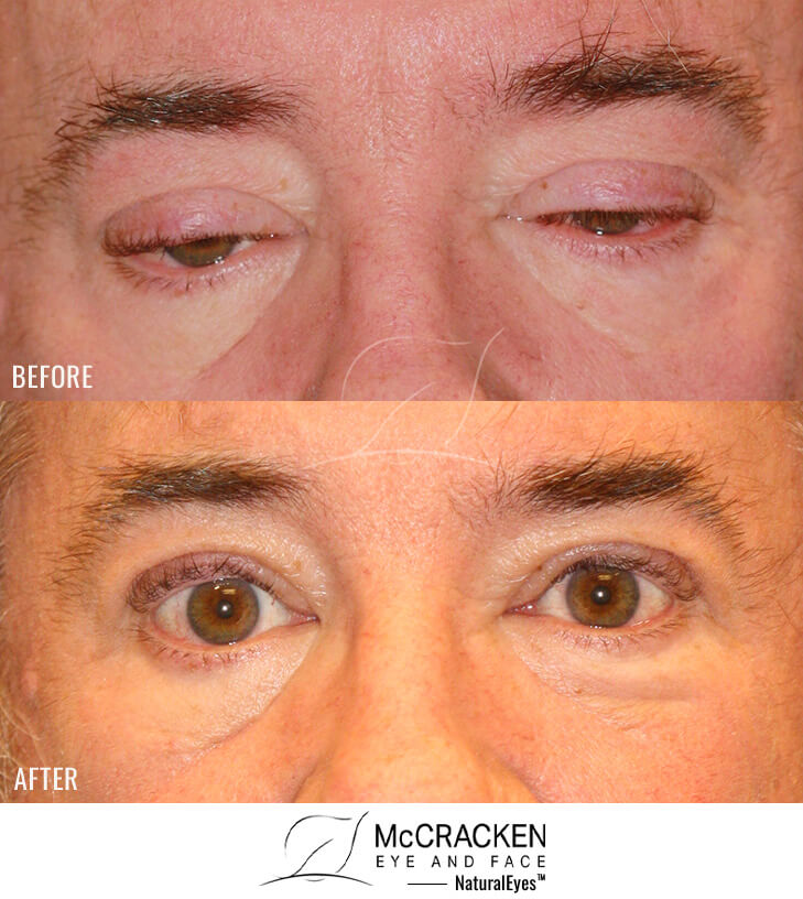 60 year old male– Bilateral Upper Eyelid Ptosis (Droopy Eyelids) Repair
