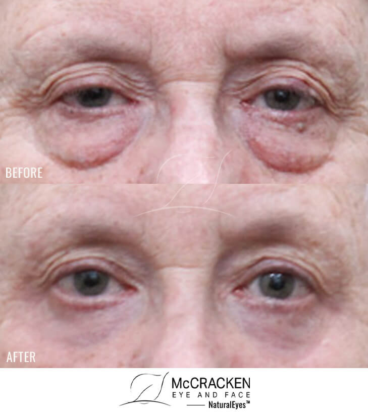 74 Year Old Female – Bilateral Upper Lid Ptosis Repair with Lower Blepharoplasty and Periocular Laser Skin Resurfacing. No Skin Incisions.