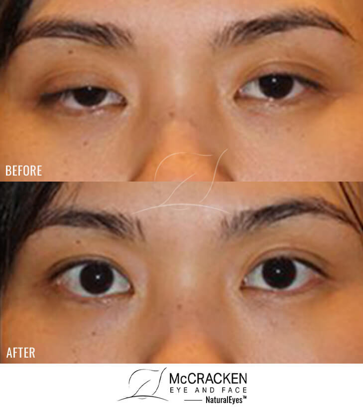 39 year old female – Upper Eyelid Ptosis (Droopy Eyelids) Repair