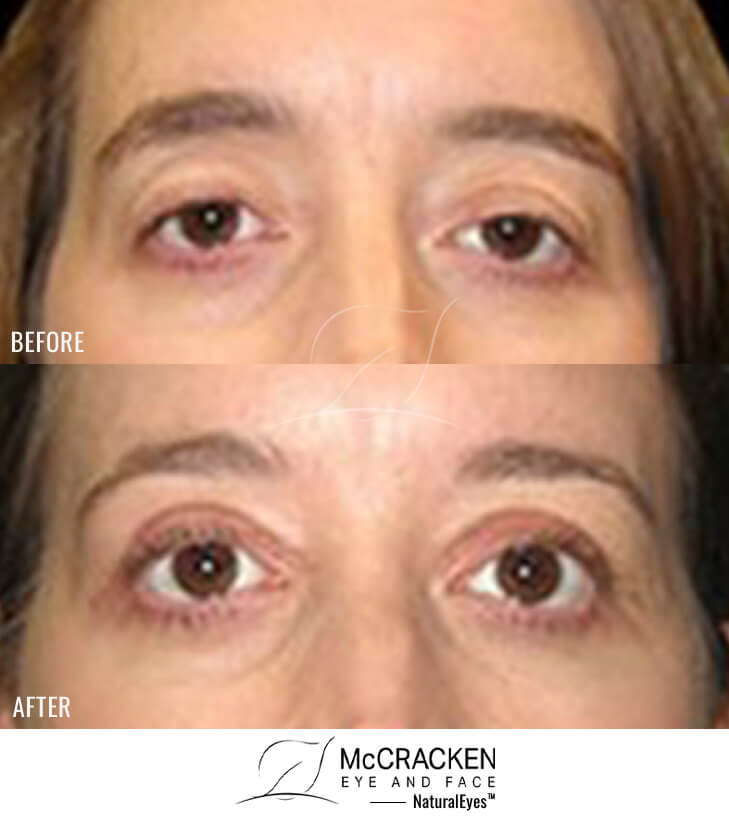 42 Year Old Female – Bilateral Upper Eyelid Ptosis (Droopy Eyelids) Repair