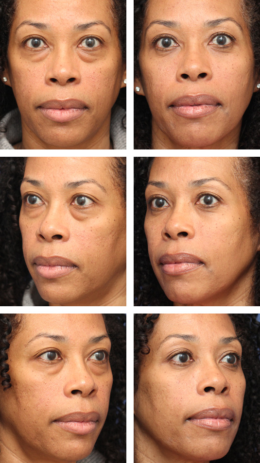  Before and After Picture 
49 Year Old Female – Upper and Lower Blepharoplasty.  No lower lid skin incisions were made.