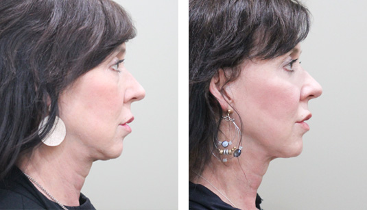  Before and After Picture 
58 year old female – AccuTite to the neck and Jowls and Morpheus8 (RF microneedling) to the face and neck
