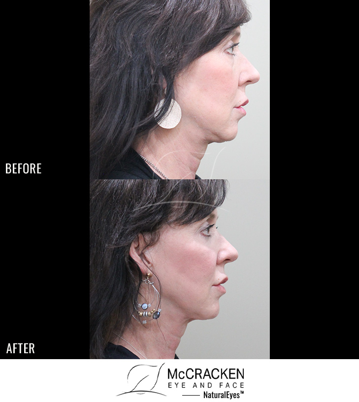 58 year old female – AccuTite to the neck and Jowls and Morpheus8 (RF microneedling) to the face and neck