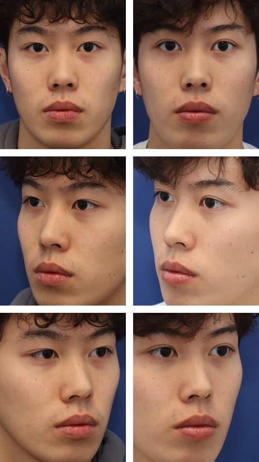 Before and After Picture
22 Year Old Male – Upper Blepharoplasty
Before and After Picture
22 Year Old Male – Upper Blepharoplasty