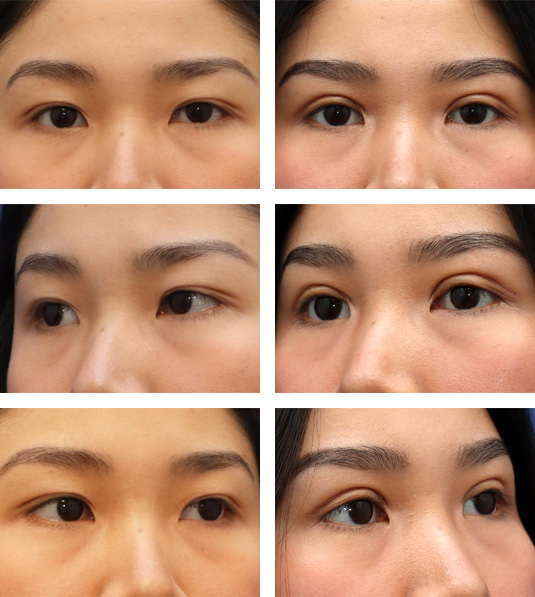  Before and After Picture 
23 Year Old Female. Bilateral Upper Lid Westernizing Blepharoplasty.  This patient wanted her eyelids to look more Western and less Asian.  She has a small left upper lid scar from an attempt elsewhere to correct her lids with threading.
