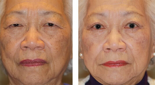  Before and After Picture 
83 year old female - Upper Blepharoplasty