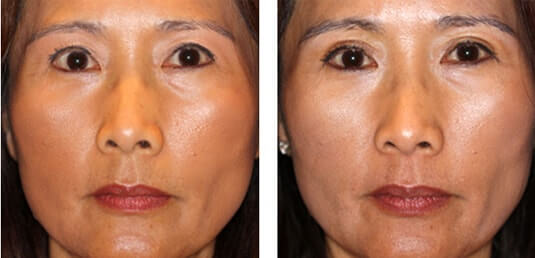  Before and After Picture 
52 year old female - Upper Blepharoplasty