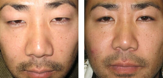  Before and After Picture 
32 Year Old Male - Upper Blepharoplasty