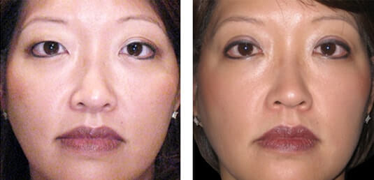  Before and After Picture 
38 Year Old Female - Upper Blepharoplasty