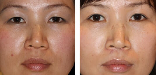  Before and After Picture 
23 Year Old Female - Upper Blepharoplasty