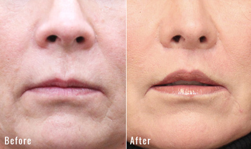 before after lip lift patient 2