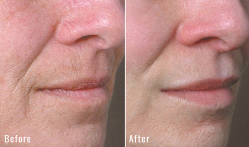 before after lip lift patient 3