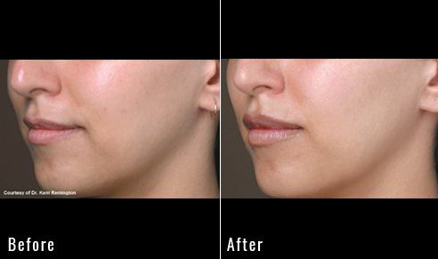 before after lip lift patient 4