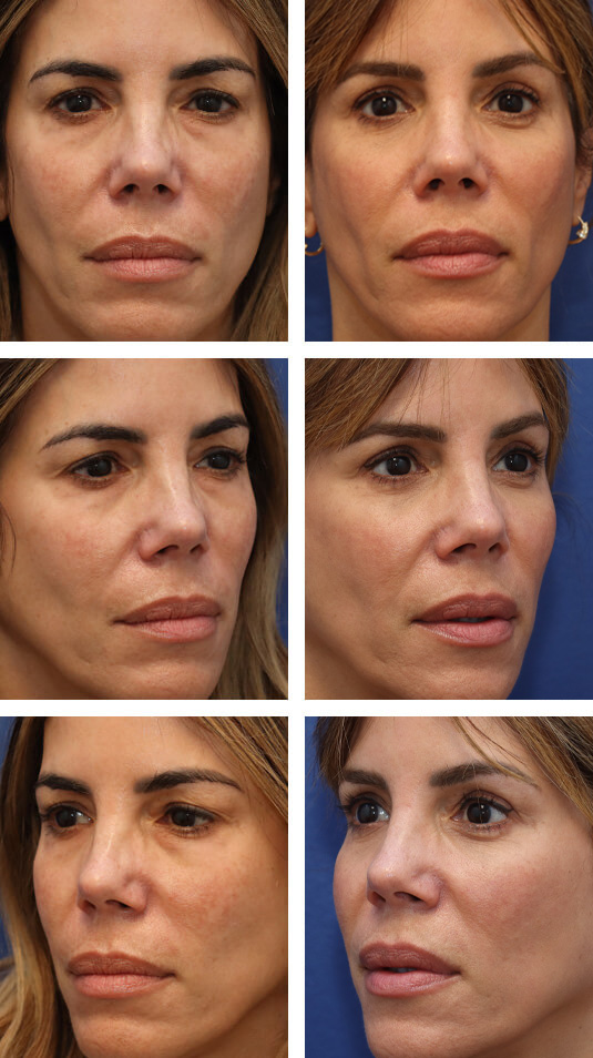  Before and After Picture 
54 Year Old Female – Lower Lid Blepharoplasty with Fat Repositioning, Injection of 4cc of Fat to Each Cheek. No Lower Lid Skin Incisions were made.