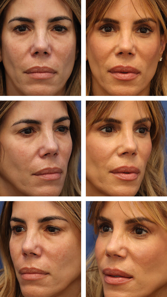  Before and After Picture  
54 Year Old Female – Lower Lid Blepharoplasty with Fat Repositioning, Injection of 4cc of Fat to Each Cheek. No Lower Lid Skin Incisions were made.