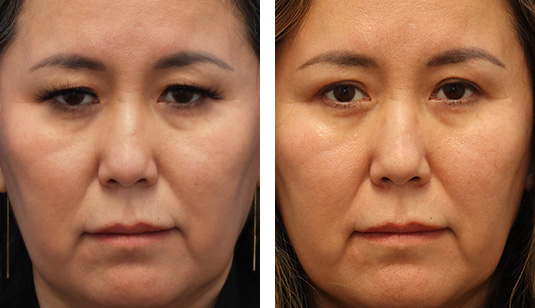  Before and After Picture 
47 year Old Female - Upper Blepharoplasty