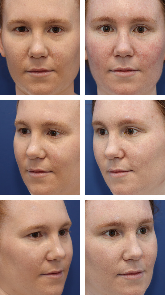  Before and After Picture 
34 Year Old Female – Endoscopic Brow Lift Fixated with EndoTines. The Patient is Shown 1 Week Postop.