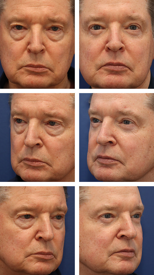  Before and After Picture 
71 Year Old Male – Upper and Lower Blepharoplasty with skin pinch incision.