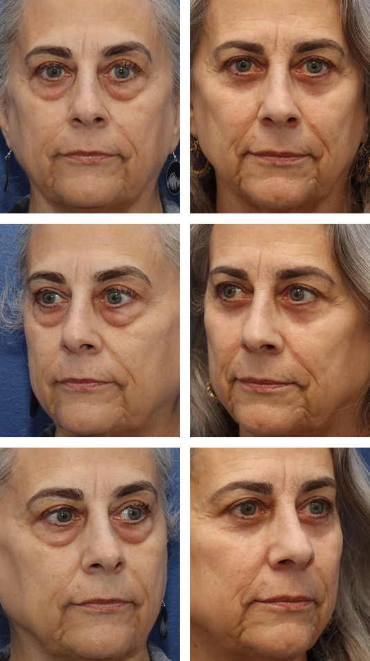  Before and After Picture 
63 Year Old Female – Bilateral Lower Lid Blepharoplasty Injection of 3.5cc of Fat to Each Cheek, and Laser Skin Resurfacing. No Lower Lid Skin Incisions were made.