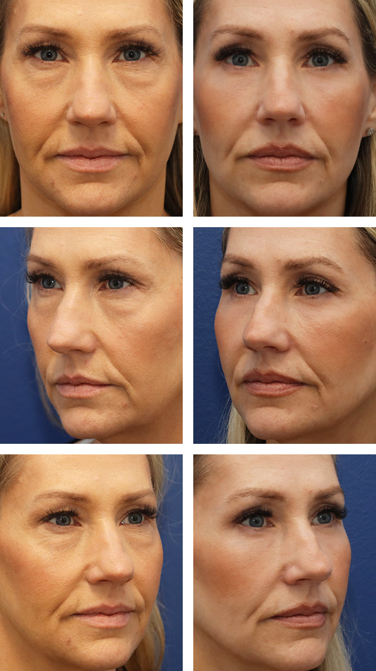  Before and After Picture 
48 Year Old Female – Lower Lid Blepharoplasty with Fat Excision, Injection of 3cc of Fat to Each Cheek and Tear Trough, and Laser Skin Resurfacing. No Lower Lid Skin Incisions were made.