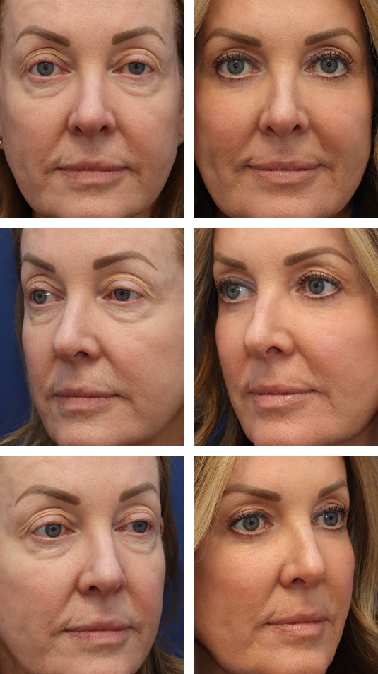  Before and After Picture 
58 Year Old Female – Upper and Lower Lid Blepharoplasty with Fat Repositioning, Left Upper Lid Ptosis Repair, Injection of 4cc of Fat to Each Cheek, and Laser Skin Resurfacing. No Lower Lid Skin Incisions were made.