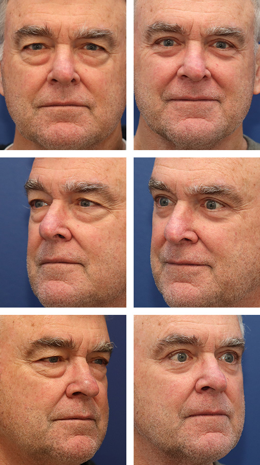 Before and After Picture 
63 Year Old Male – Upper and Lower Blepharoplasty with Internal Brow Lift and Laser Skin Resurfacing. No lower lid skin incisions were made.
