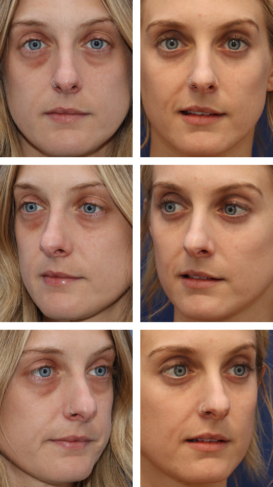  Before and After Picture 
36 Year Old Female – Lower Lid Blepharoplasty with Fat Repositioning, Injection of 4cc of Fat to Each Cheek and Laser Skin Resurfacing. No Lower Lid Skin Incisions were made.
