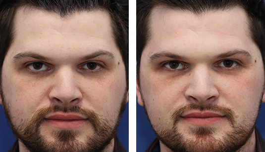  Before and After Picture 
31 Year Old Male – Repair of Right Lower Lid Retraction With EnduraGen Spacer Graft After Eyelid Surgery Elsewhere