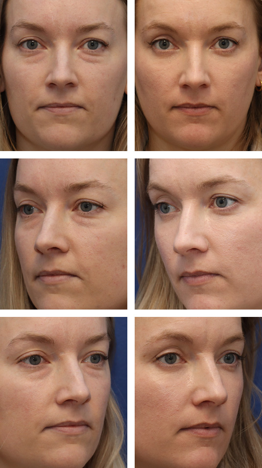  Before and After Picture 
34 Year Old Female – Lower Lid Blepharoplasty with Fat Repositioning and Laser Skin Resurfacing. No Lower Lid Skin Incisions were made.