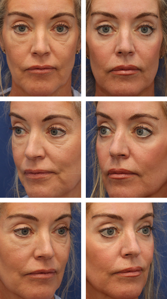  Before and After Picture 
60 Year Old Female – Lower Lid Blepharoplasty with Fat Repositioning, Injection of 5cc fat per cheek, and laser skin resurfacing. No lower lid skin incisions were made.