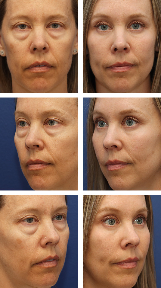  Before and After Picture 
44 Year Old Female – Upper and Lower Lid Blepharoplasty with Injection of 4cc of Fat to Each Cheek, and Laser Skin Resurfacing.