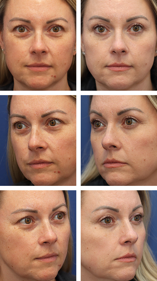  Before and After Picture 
41 Year Old Female – Upper Blepharoplasty.  The patient complained of looking tired but now people tell her she looks refreshed.