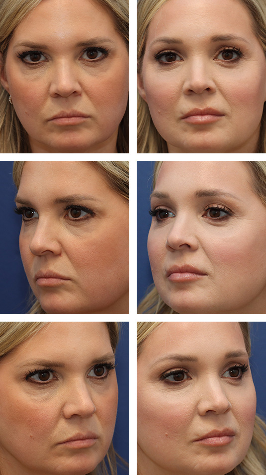  Before and After Picture 
42 Year Old Female – Endoscopic Brow Lift with Lower Blepharoplasty, Fat Transfer to the Cheeks (2cc on the Right and 3cc on the Left),  and NanoFat Injection 1cc to each Lower Lid. The brow lift was fixated with EndoTines. No lower lid skin incisions were made.