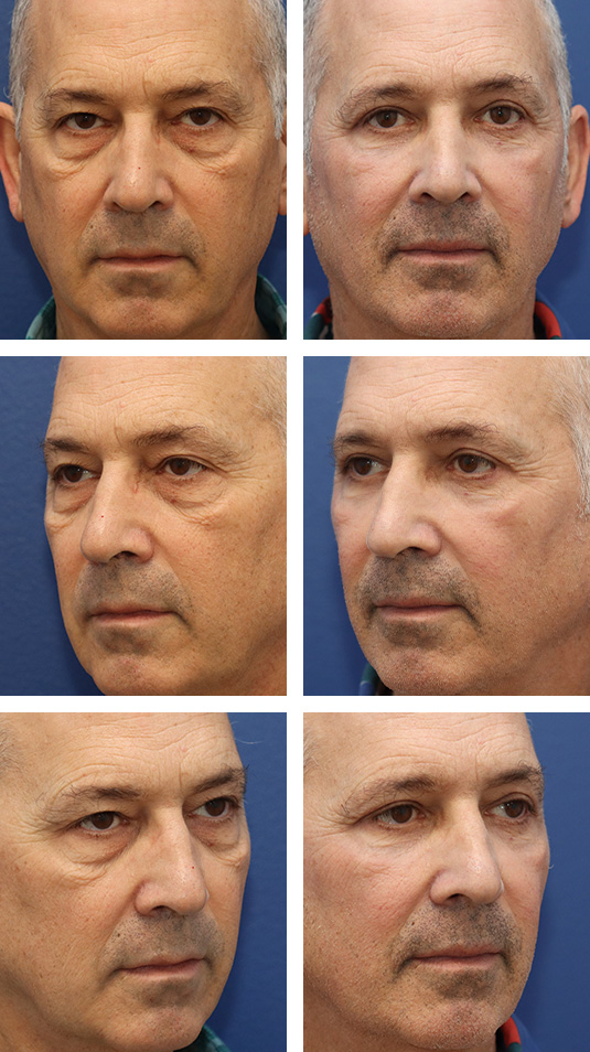  Before and After Picture 
61 Year Old Male – Upper Lid Blepharoplasty with Brow Pexies, Lower Lid Blepharoplasty with Laser Skin Resurfacing. A Skin Pinch Excision Was Used to Remove a Small Amount of Excess Skin.