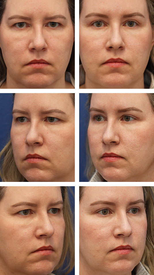  Before and After Picture 
47 Year Old Female – Endoscopic Brow Lift with Upper Blepharoplasty. The brow lift was fixated with EndoTines.