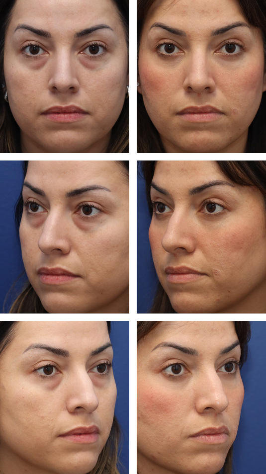  Before and After Picture 
36 Year Old Female – Lower Lid Blepharoplasty with Fat Repositioning, Injection of 3cc of Fat to Each Cheek, and injection of 1cc of nanofat to each lower lid. No Lower Lid Skin Incisions were made.