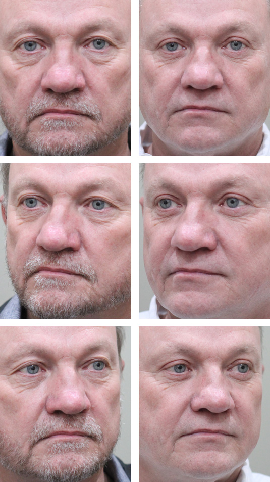  Before and After Picture 
61 Year Old Male – Upper and Lower Blepharoplasty with lower lid skin pinch excision.