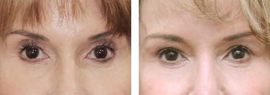  Before and After Picture 
73 year old female - Bilateral upper lid Restylane injection to correct upper lid hollowness