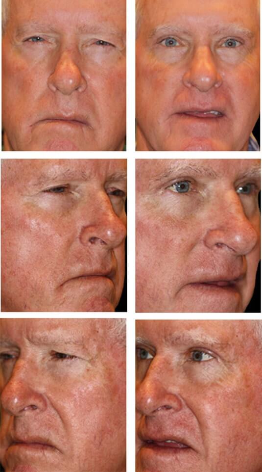  Before and After Picture 
67 Year Old Male - Upper Blepharoplasty