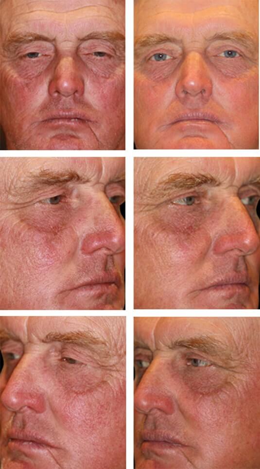  Before and After Picture 
61 Year Old Male - Upper Blepharoplasty