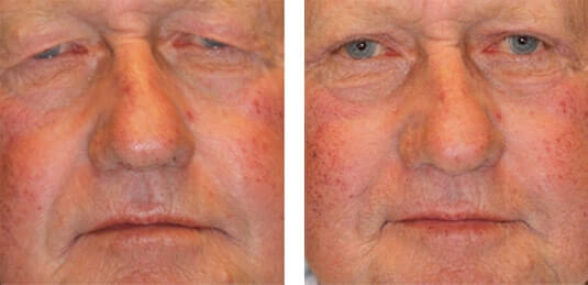  Before and After Picture 
72 Year Old Male - Upper Blepharoplasty