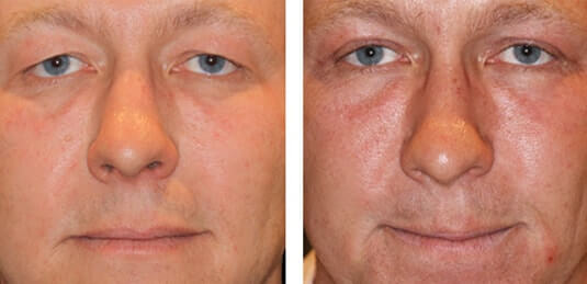  Before and After Picture 
43 Year Old Male - Upper Blepharoplasty