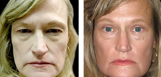  Before and After Picture 
56 Year Old Female - Upper Blepharoplasty